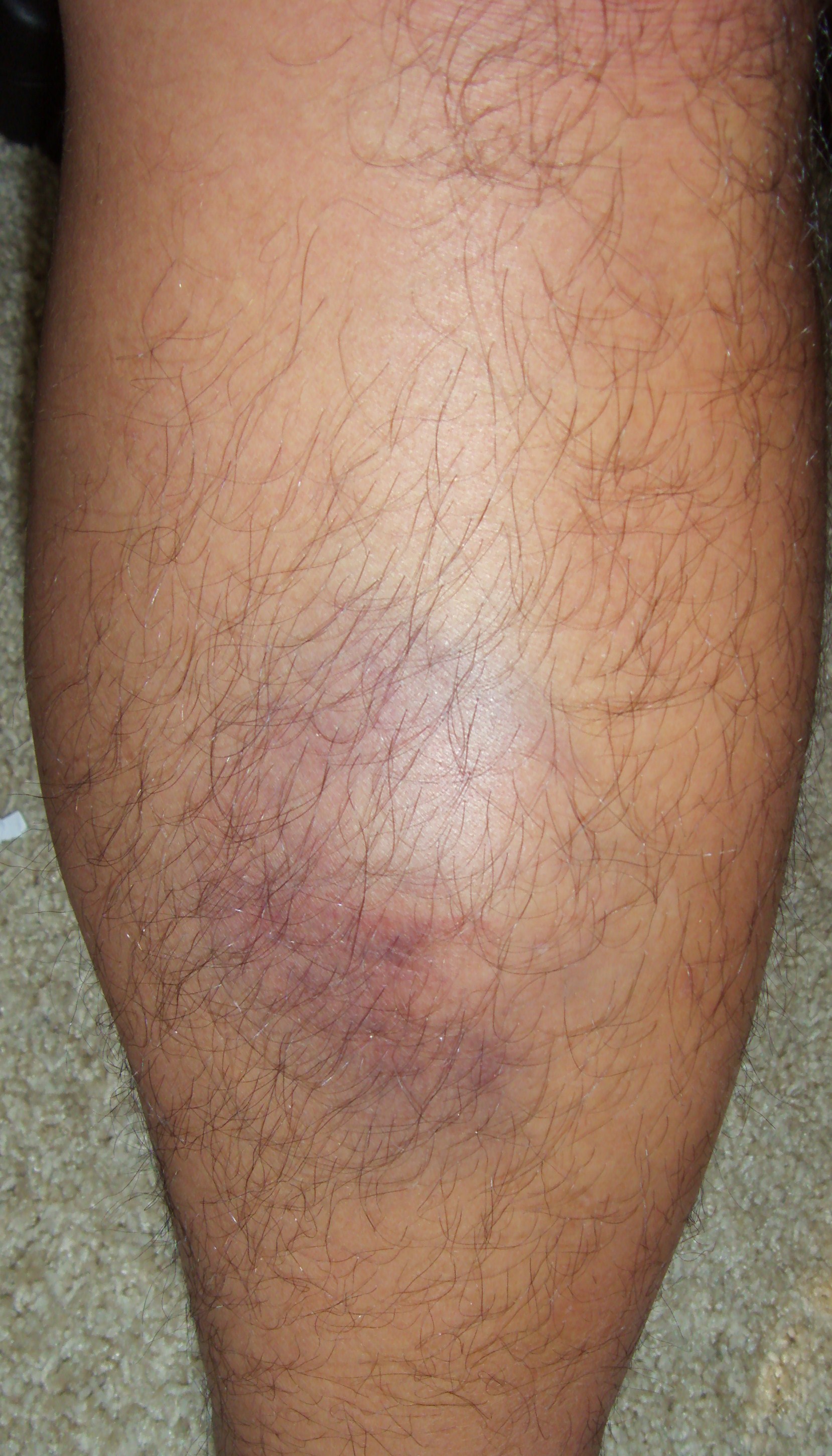 bruise2